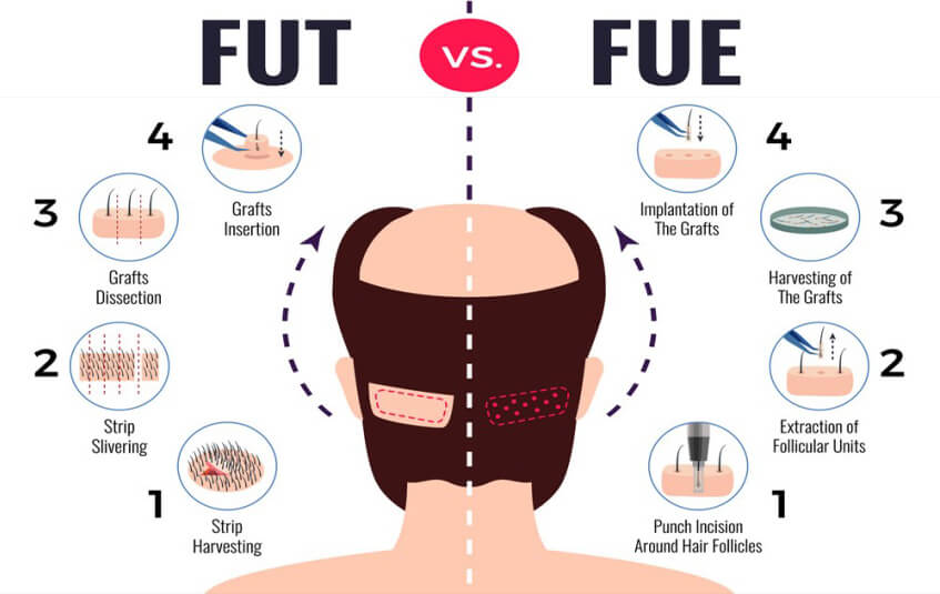 FUE extraction diagram