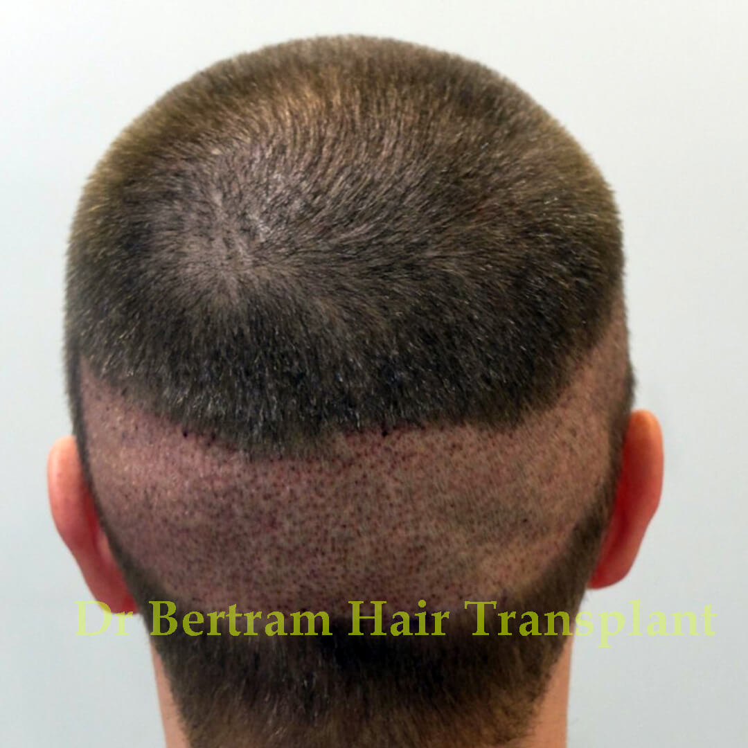 Patient donor area before surgery