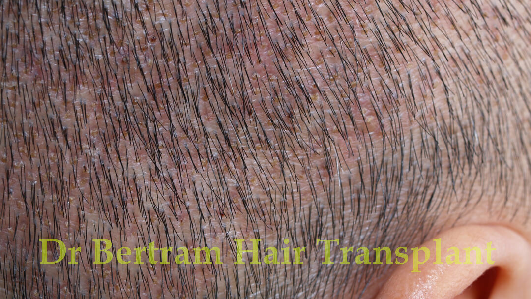 Example of patchy donor area due to over-harvesting