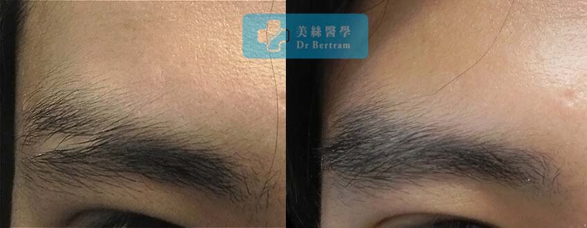 臨床個案：男性眉毛疤痕修復