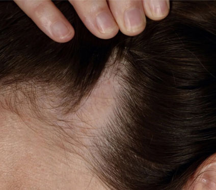 Diffuse thinning