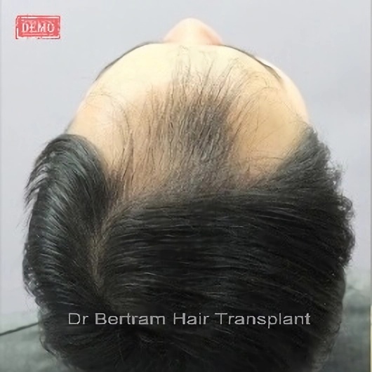 術前：顳部後移
