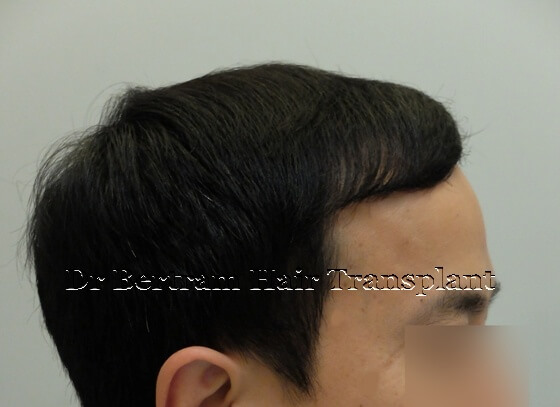術後12個月：右側角度