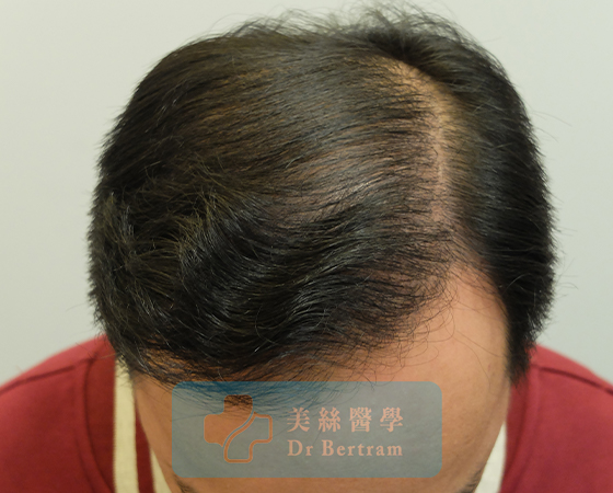 術後12個月：頭頂中部角度