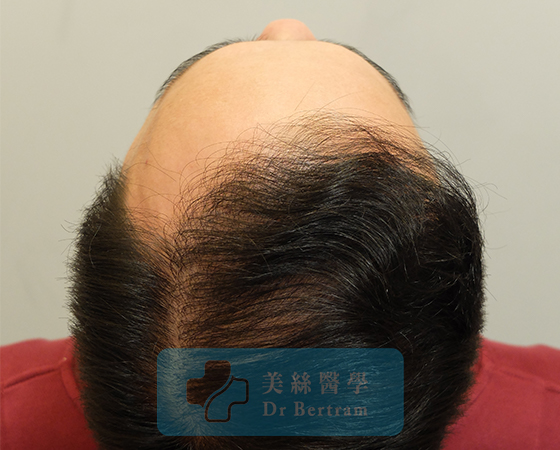術後12個月：左側角度