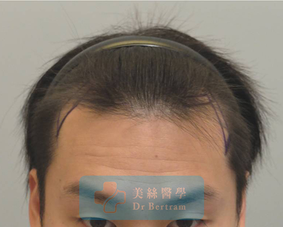 術前：III期前額髮際線上移