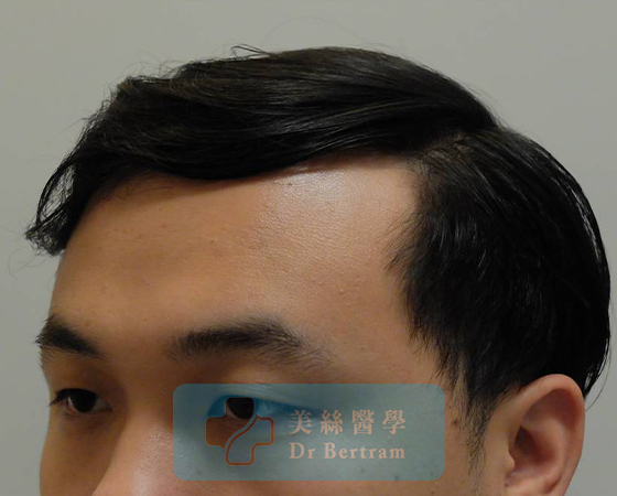 術後：覆蓋改善