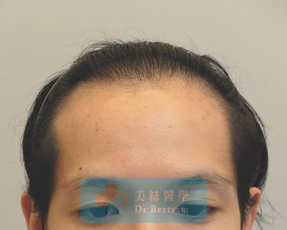術後12個月：髮際線恢復