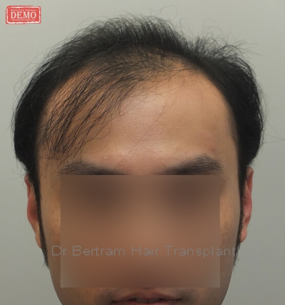 術前：正面角度，V期脫髮模式