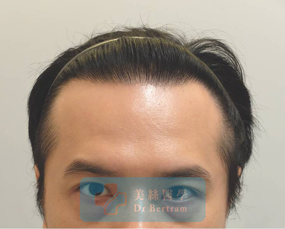 術後12個月：髮際線恢復