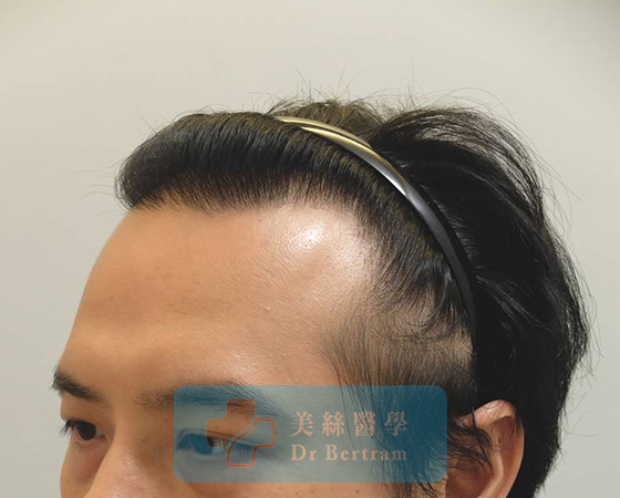 術後：自然過渡