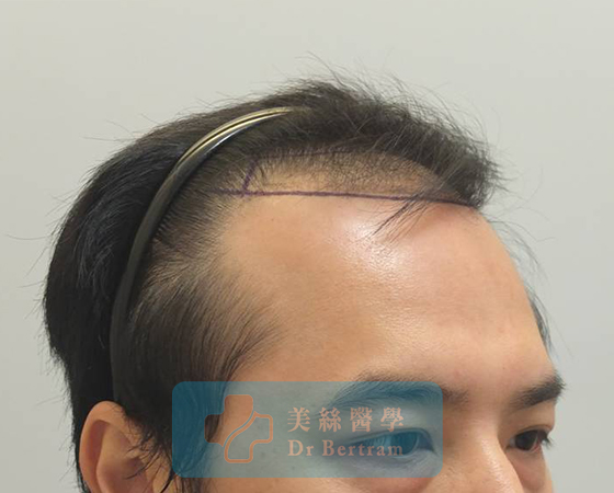 術前：顳部後移
