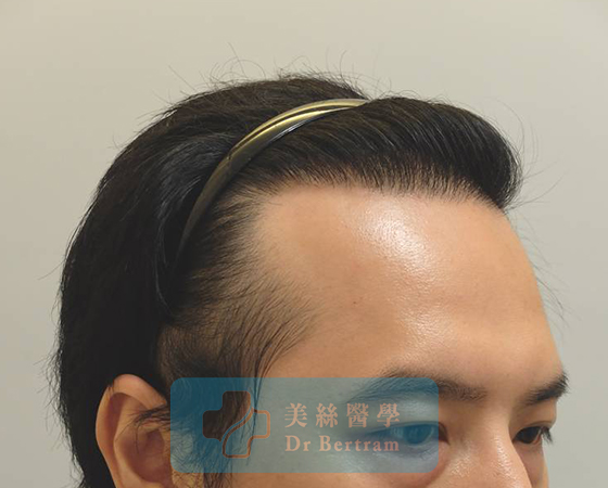 術後：顳部連接恢復