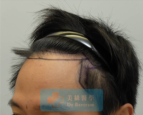 術前：頭頂中部，頭頂穩定