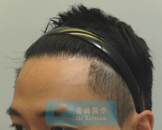 術後：自然過渡