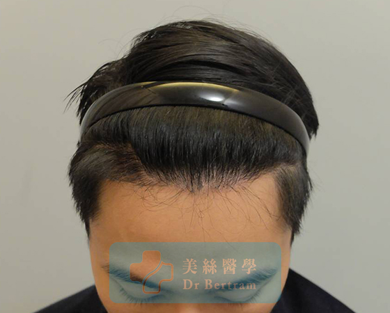 術後：顳部連接恢復