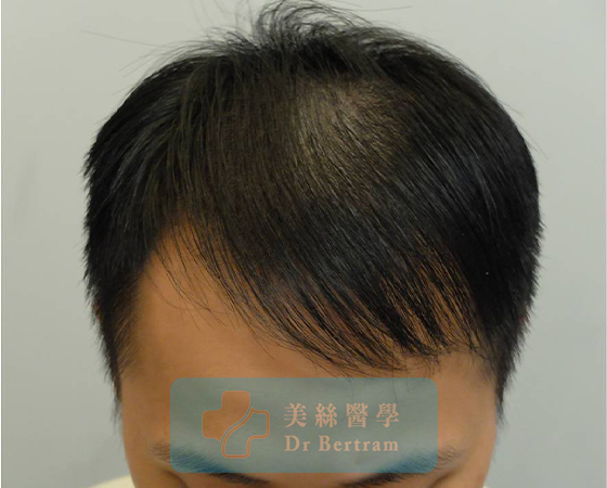 術後：顳部連接恢復