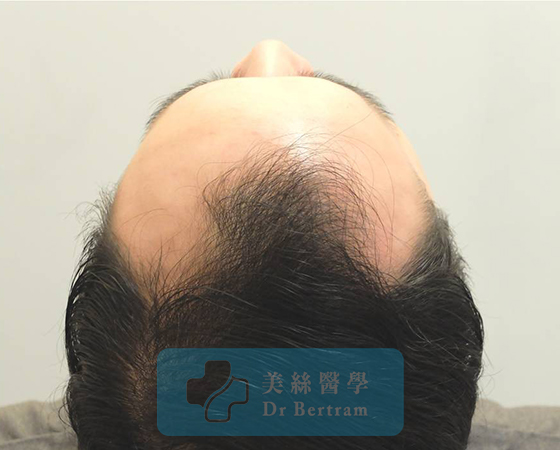術前：側面顳部後移