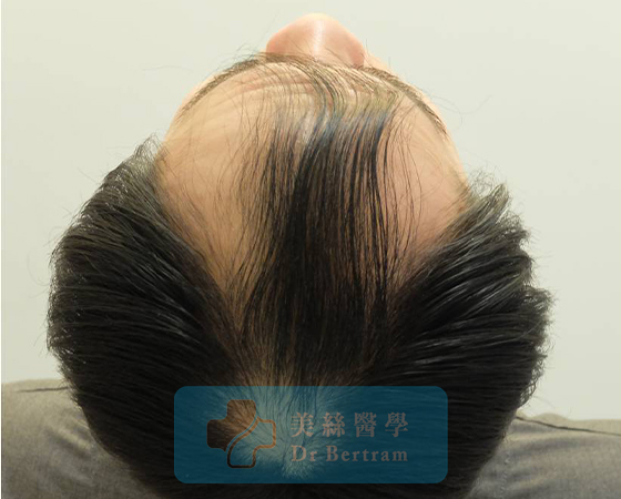 術前：側面顳部後移