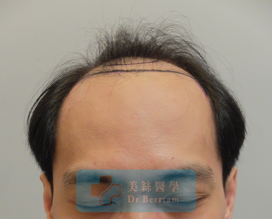 術前：側面顳部後移