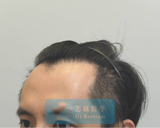 術後12個月：髮際線恢復