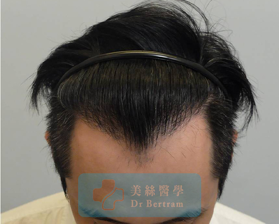 術後：自然過渡