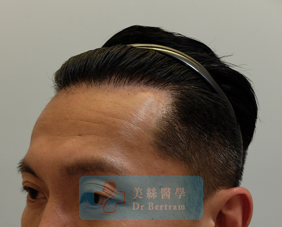 術後：自然過渡
