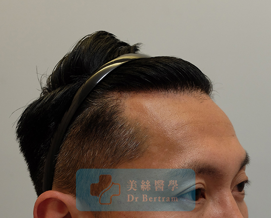 術後：顳部連接恢復