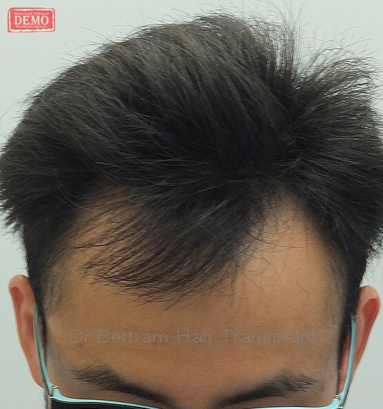 術前：正面角度，V期脫髮模式
