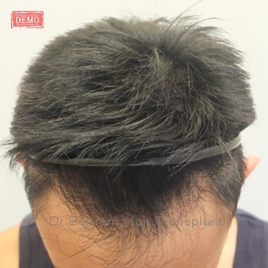 術後12個月：後方角度