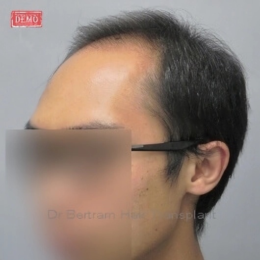 術前：後方角度