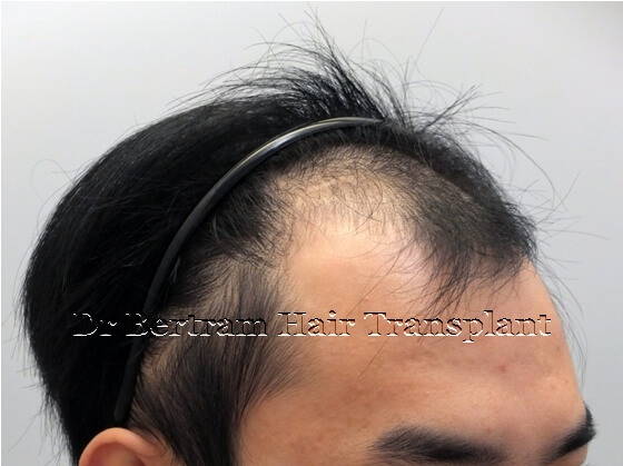 術前：後方角度