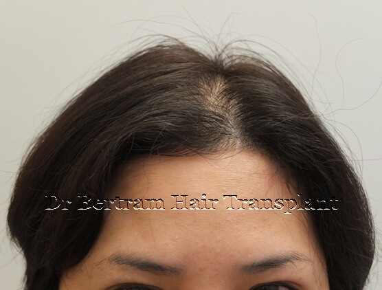 個案1 女性術前：側面角度顯示頭皮可見