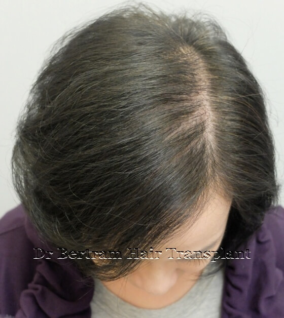個案2 女性術後12個月：分界線密度提升