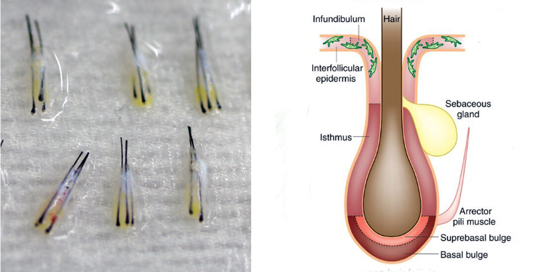 Advanced FUE utilizes precision instrumentation
