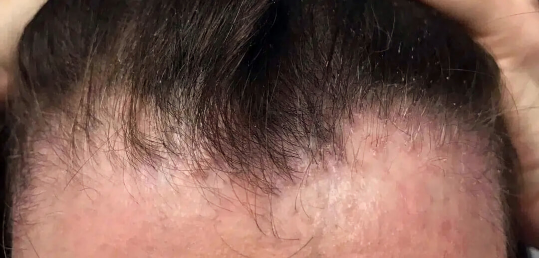 牽引性脫髮髮上移
