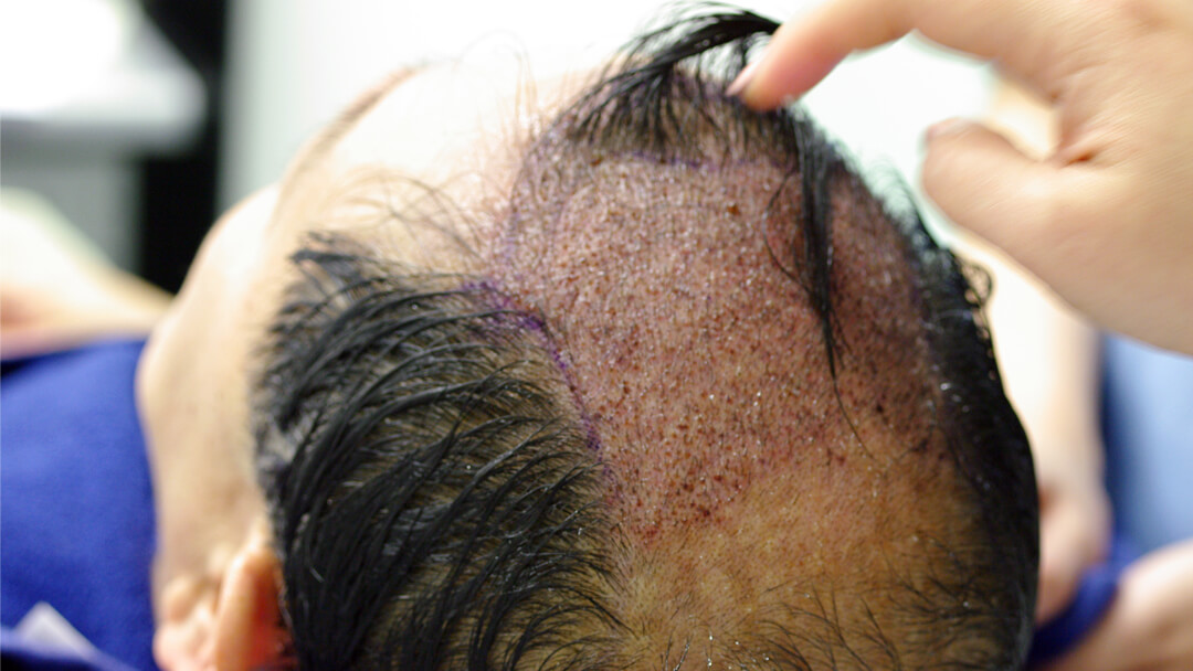 Patient donor area 12 months after surgery